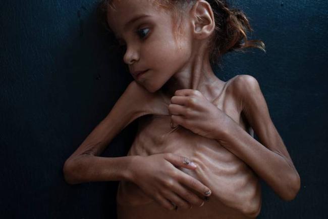Πέθανε σε ηλικία 7 ετών το κορίτσι - σύμβολο του λιμού στην Υεμένη