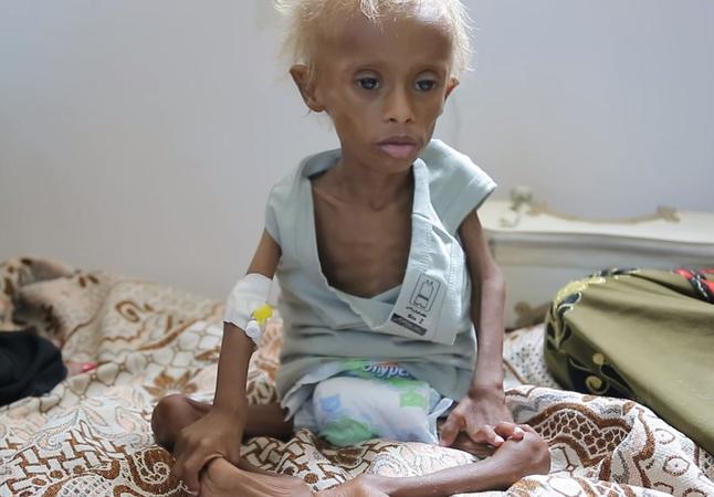 Πώς είναι σήμερα το αγόρι από την Υεμένη που σόκαρε τον κόσμο πριν από ένα χρόνο [ΒΙΝΤΕΟ]
