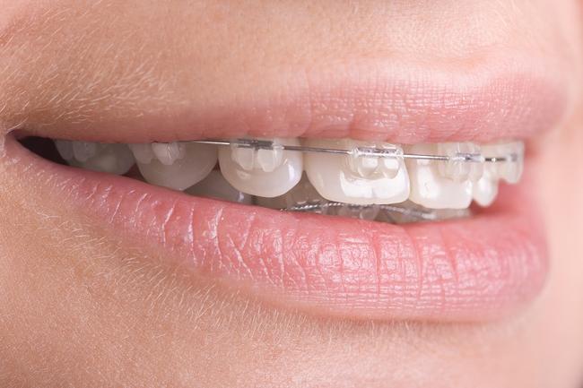 7 Μύθοι για τα δόντια και την Ορθοδοντική
