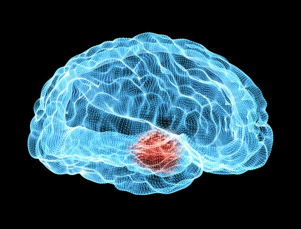 Πάρκινσον: Τι πρέπει να γνωρίζουμε για τον «βηματοδότη» εγκεφάλου
