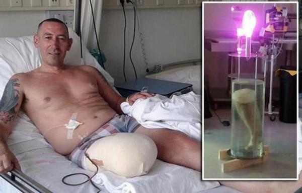 Ολλανδία: 53χρονος έβγαλε στο "σφυρί" το πόδι του μέσω e-bay...
