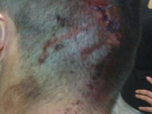 ΕΠΕΙΓΟΝ: Τραυματίες κοντά στο Hilton από χτυπήματα γκλόμπ στο κεφάλι